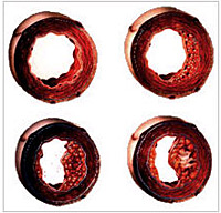 http://www.news.medizin-2000.de/bilder/2010/arteriosklerose_msd.jpg